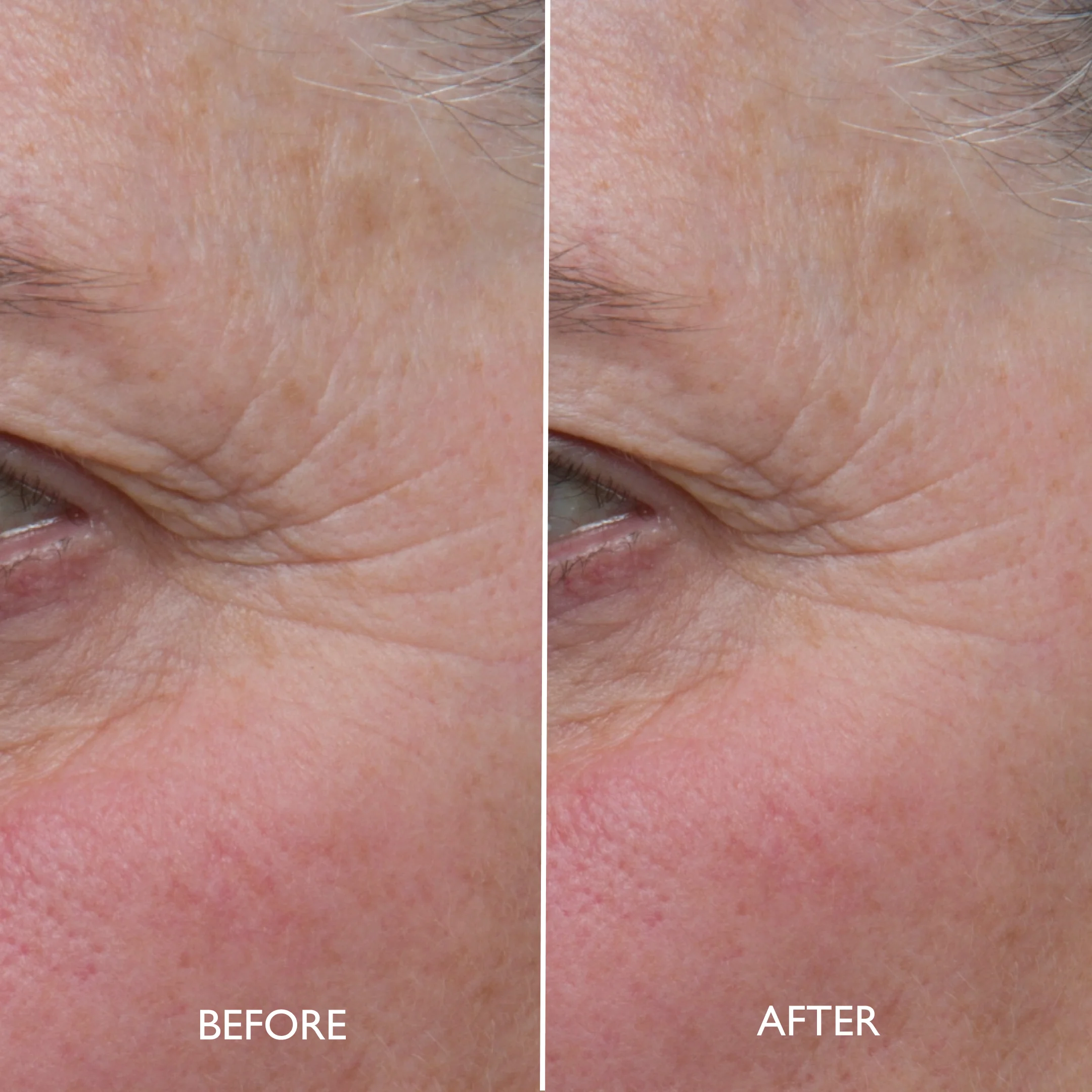 Age Benefit™ Refining Multi Acid Peel - Image 8