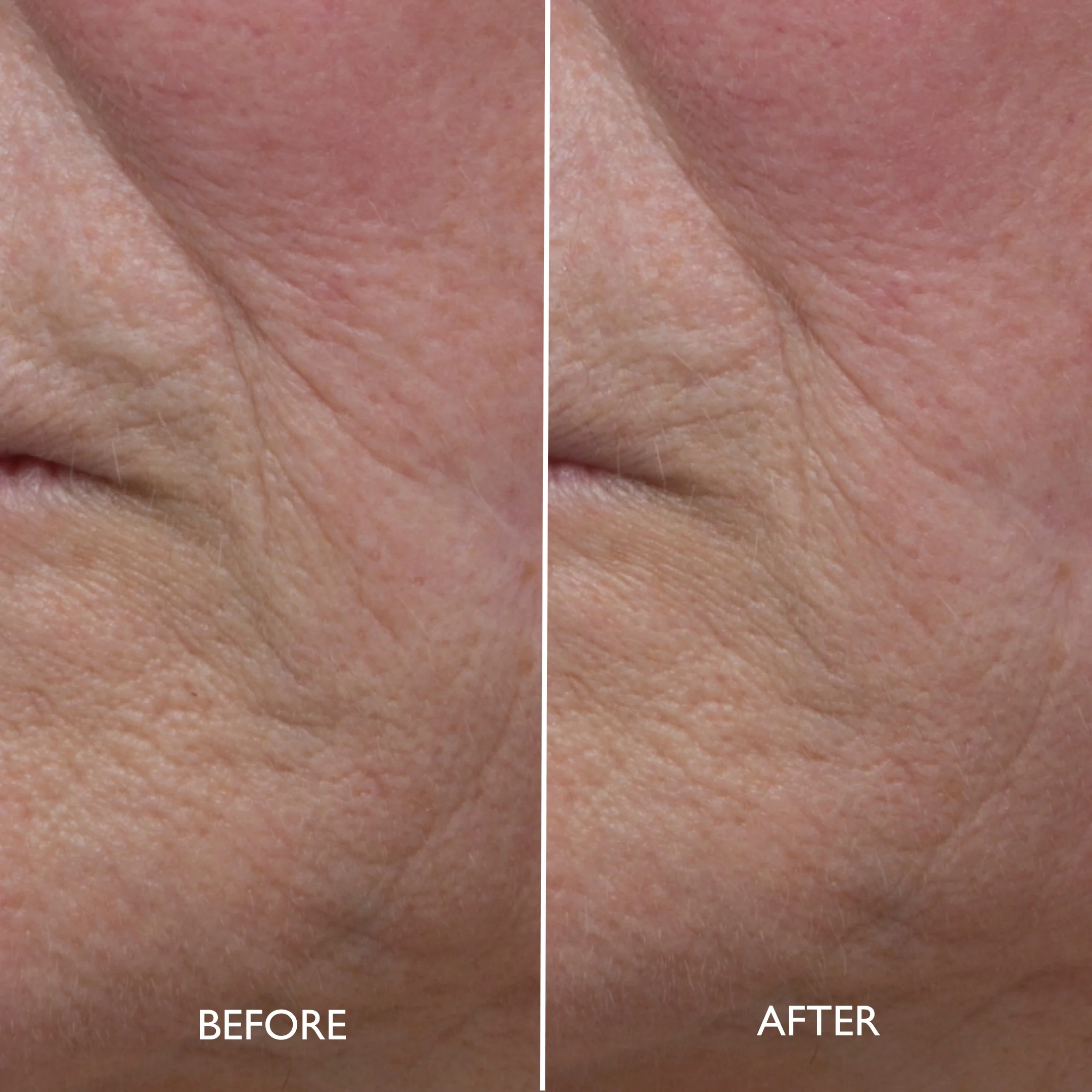 Age Benefit™ Refining Multi Acid Peel - Image 9